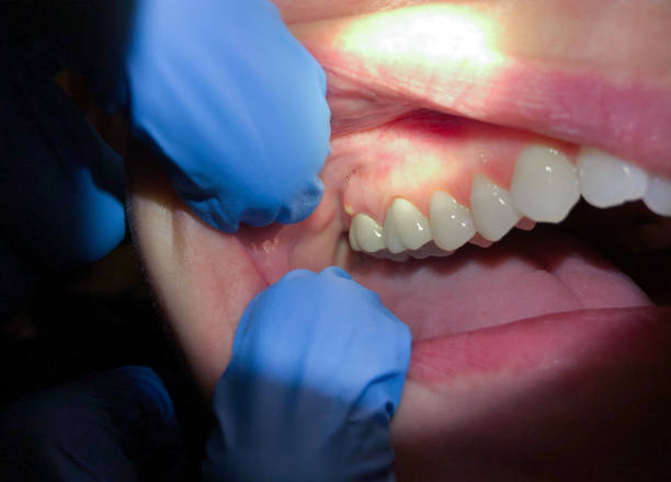 Best Emergency Dentist for Knocked-Out Tooth in Rollingwood, TX